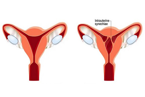 چسبندگی رحم