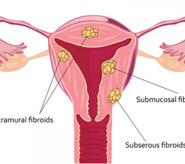 فیبروم رحم