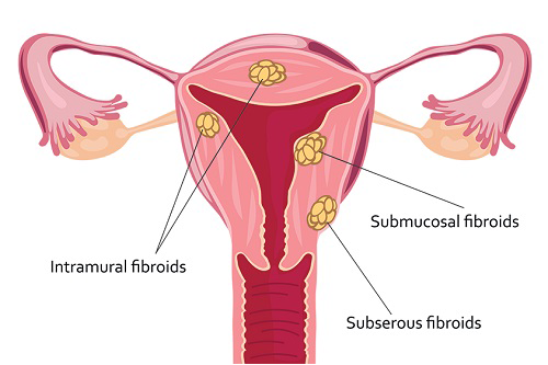 فیبروم رحم