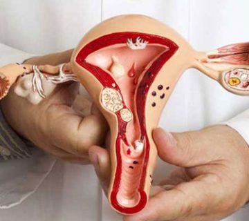 Cervical Cancer