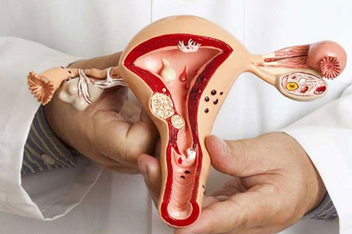 Cervical Cancer