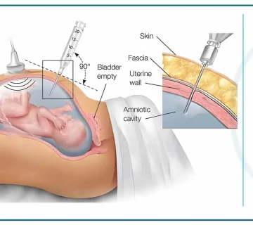 تصویر انجام آزمایش آمینوسنتز و نمونه‌گیری از مایع آمنیوتیک برای بررسی سلامت جنین