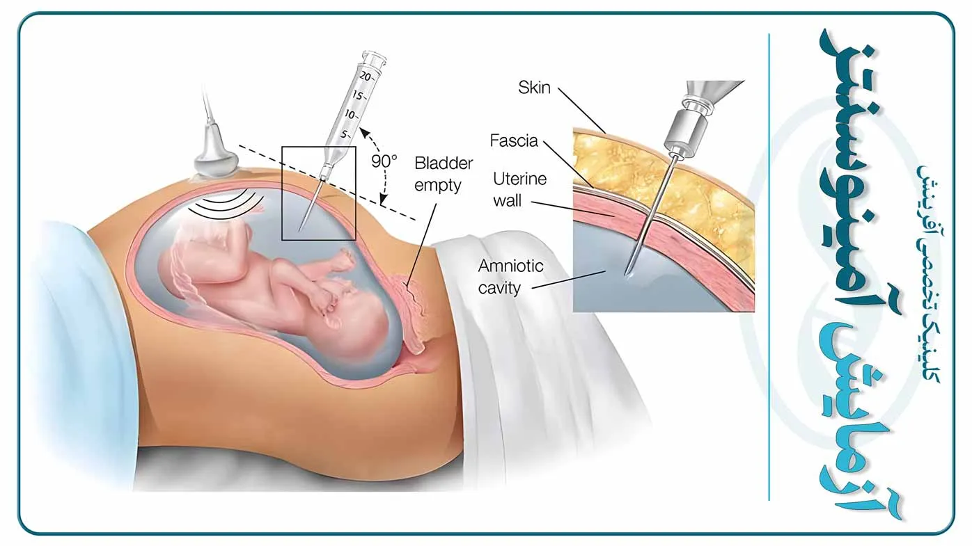 تصویر انجام آزمایش آمینوسنتز و نمونه‌گیری از مایع آمنیوتیک برای بررسی سلامت جنین