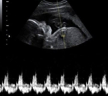 اکو قلب جنین