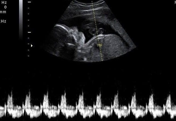 اکو قلب جنین