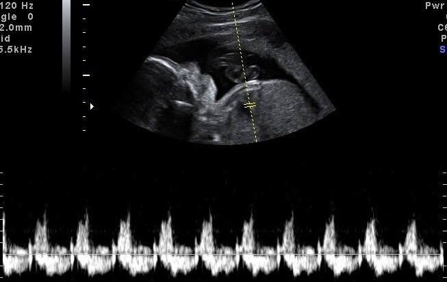 اکو قلب جنین