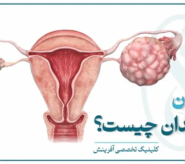 تصویر شماتیک دستگاه تناسلی زن و محل درگیری سرطان تخمدان