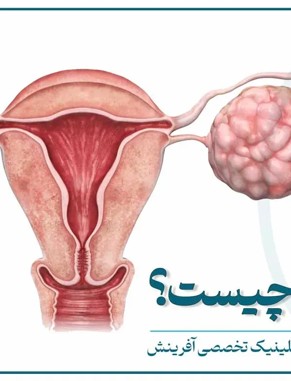 تصویر شماتیک دستگاه تناسلی زن و محل درگیری سرطان تخمدان