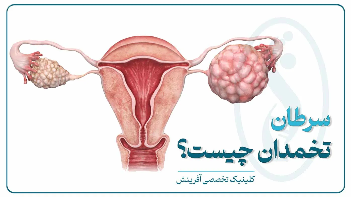 تصویر شماتیک دستگاه تناسلی زن و محل درگیری سرطان تخمدان