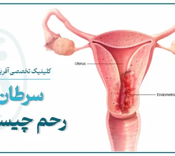 تصویر شماتیک رحم زن و محل درگیری سرطان رحم یا سرطان آندومتر