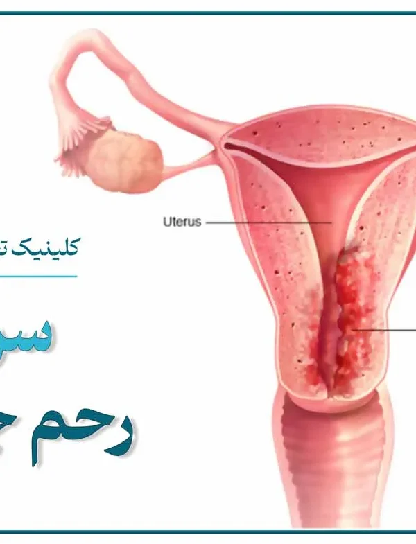 تصویر شماتیک رحم زن و محل درگیری سرطان رحم یا سرطان آندومتر