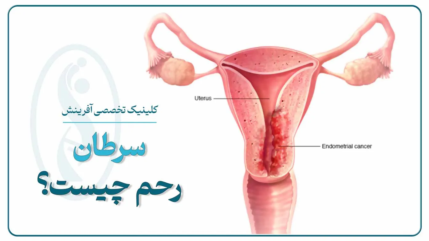 تصویر شماتیک رحم زن و محل درگیری سرطان رحم یا سرطان آندومتر