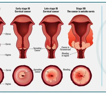 تصویر انجام آزمایش پاپ اسمیر برای غربالگری و تشخیص زودهنگام سرطان دهانه رحم در بانوان