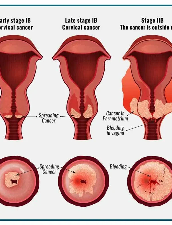 تصویر انجام آزمایش پاپ اسمیر برای غربالگری و تشخیص زودهنگام سرطان دهانه رحم در بانوان
