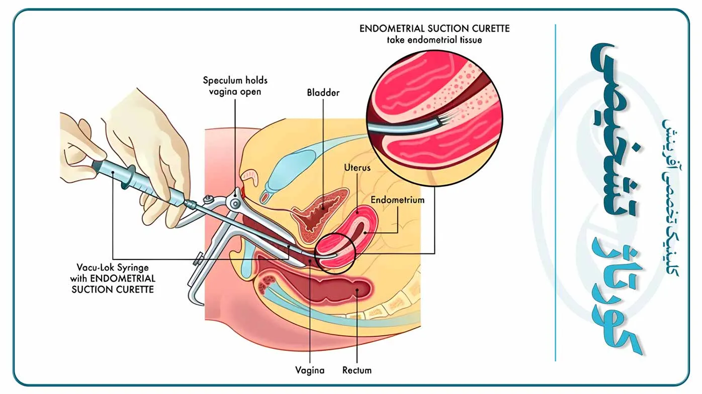 تصویر تجهیزات پزشکی و نمونه‌برداری برای کورتاژ تشخیصی و بررسی سلول‌های رحم